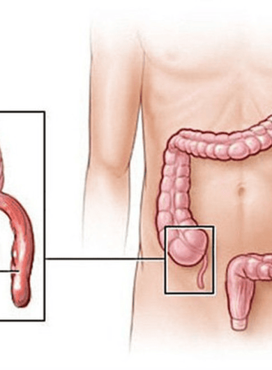 Viêm Ruột Thừa Cấp – Triệu Chứng, Chẩn Đoán Và Hướng Điều Trị