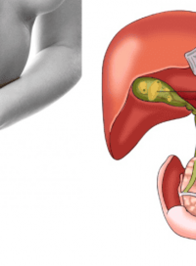 Polyp túi mật có cần phẫu thuật không ?