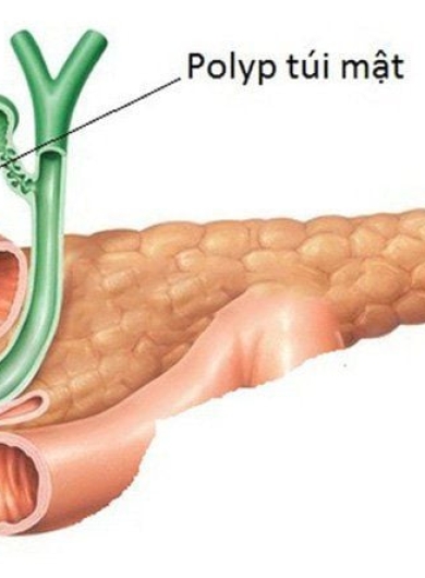 U Cơ Tuyến Túi Mật – Bệnh Lý Ít Gặp Nhưng Nguy Hiểm