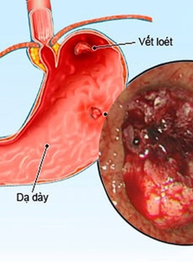 Viêm Loét Dạ Dày – Tá Tràng Và Trào Ngược Dạ Dày Thực Quản: Nguyên Nhân, Dấu Hiệu Và Hướng Điều Trị