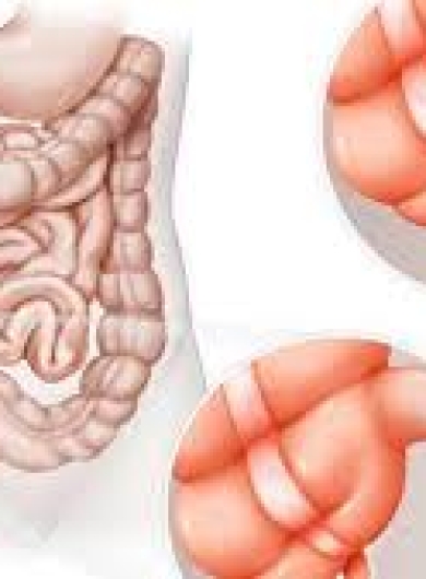 Viêm ruột thừa cấp: Triệu chứng, chẩn đoán và điều trị