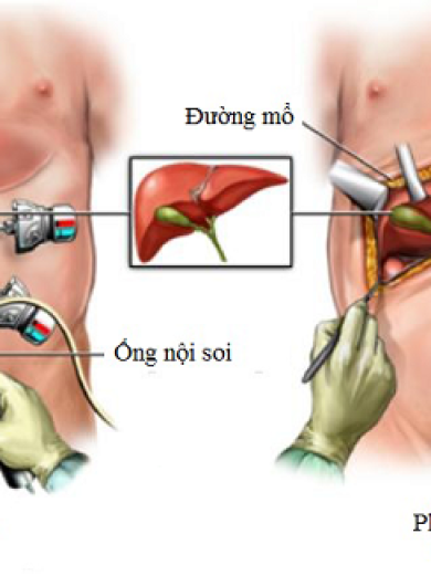 Sỏi túi mật có nguy hiểm không? Khi nào cần phẫu thuật?