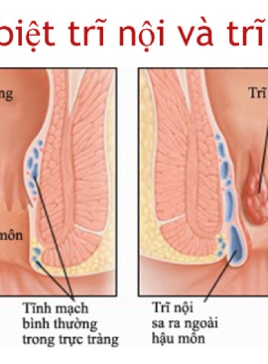 Trĩ nội và trĩ ngoại khác nhau thế nào? Cách nhận biết sớm