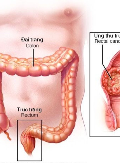 Dấu Hiệu Cảnh Báo Ung Thư Đại Trực Tràng Bạn Không Nên Bỏ Qua