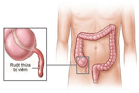 Viêm Ruột Thừa Cấp – Triệu Chứng, Chẩn Đoán Và Hướng Điều Trị