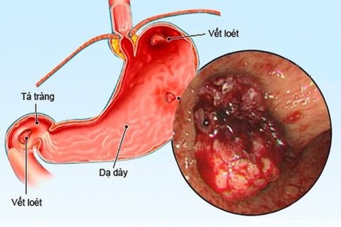 Viêm Loét Dạ Dày – Tá Tràng Và Trào Ngược Dạ Dày Thực Quản: Nguyên Nhân, Dấu Hiệu Và Hướng Điều Trị