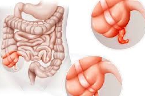 Viêm ruột thừa cấp: Triệu chứng, chẩn đoán và điều trị