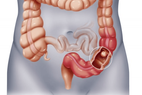 Phẫu thuật các khối u, ung thư đường tiêu hóa