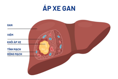 Điều trị, phẫu thuật các bệnh lý về gan, lách