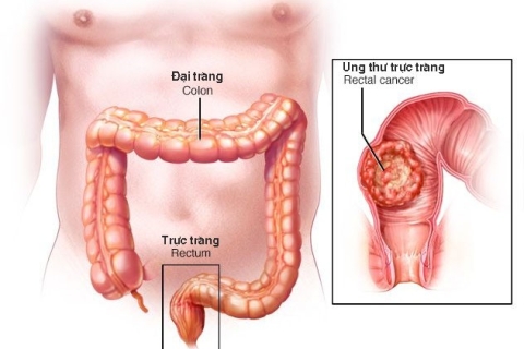 Dấu Hiệu Cảnh Báo Ung Thư Đại Trực Tràng Bạn Không Nên Bỏ Qua